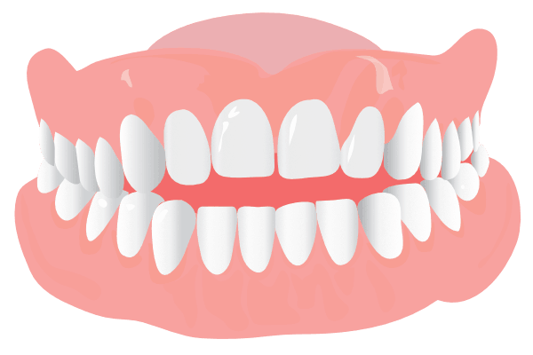 Orthodonist Treatment - Graphics of an open bite teeth structure