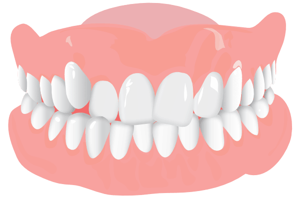 Orthodonist Treatment - Graphics of a teeth structure (Overcrowding)