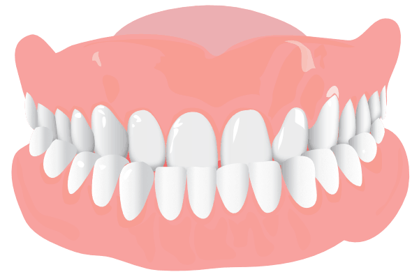 Orthodonist Treatment - Graphics of a teeth structure (Underbite)