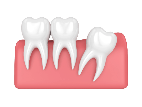 Graphics of wisdom tooth distal impaction
