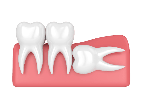 Graphics of horizontal impaction wisdom tooth