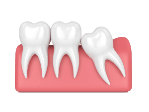 Graphics of Wisdom Tooth Mesial Impaction