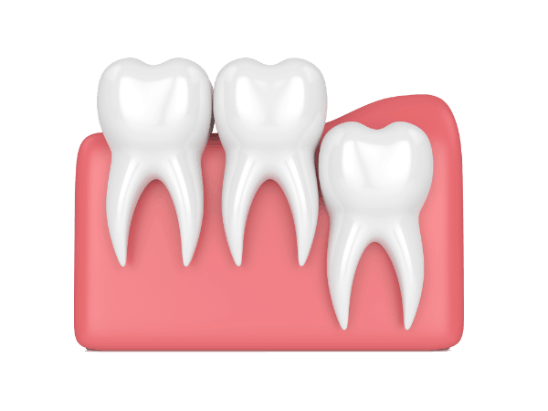 Graphics of Wisdom Tooth Vertical Impaction