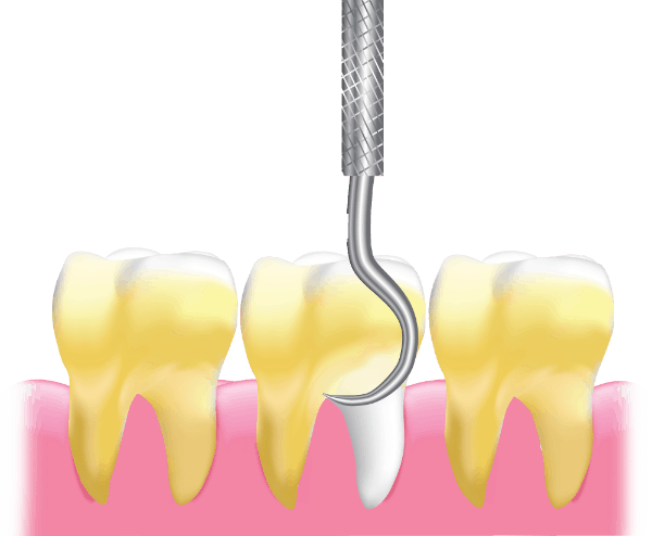 teeth scaling procedure - graphics