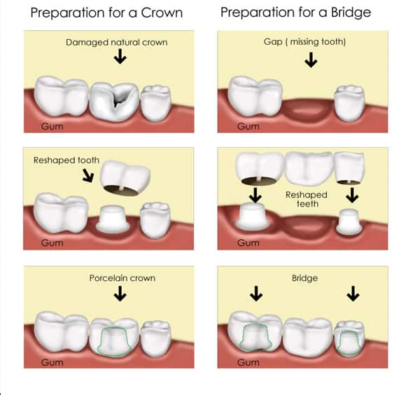 Dental Crown Vs Dental Bridge - Procedure