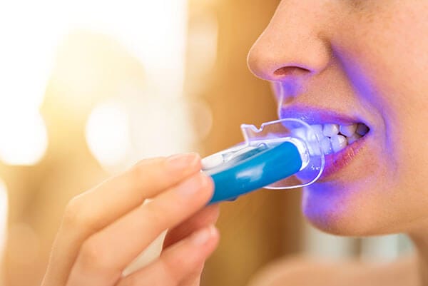 Teeth whitening kit Teeth whitening kit