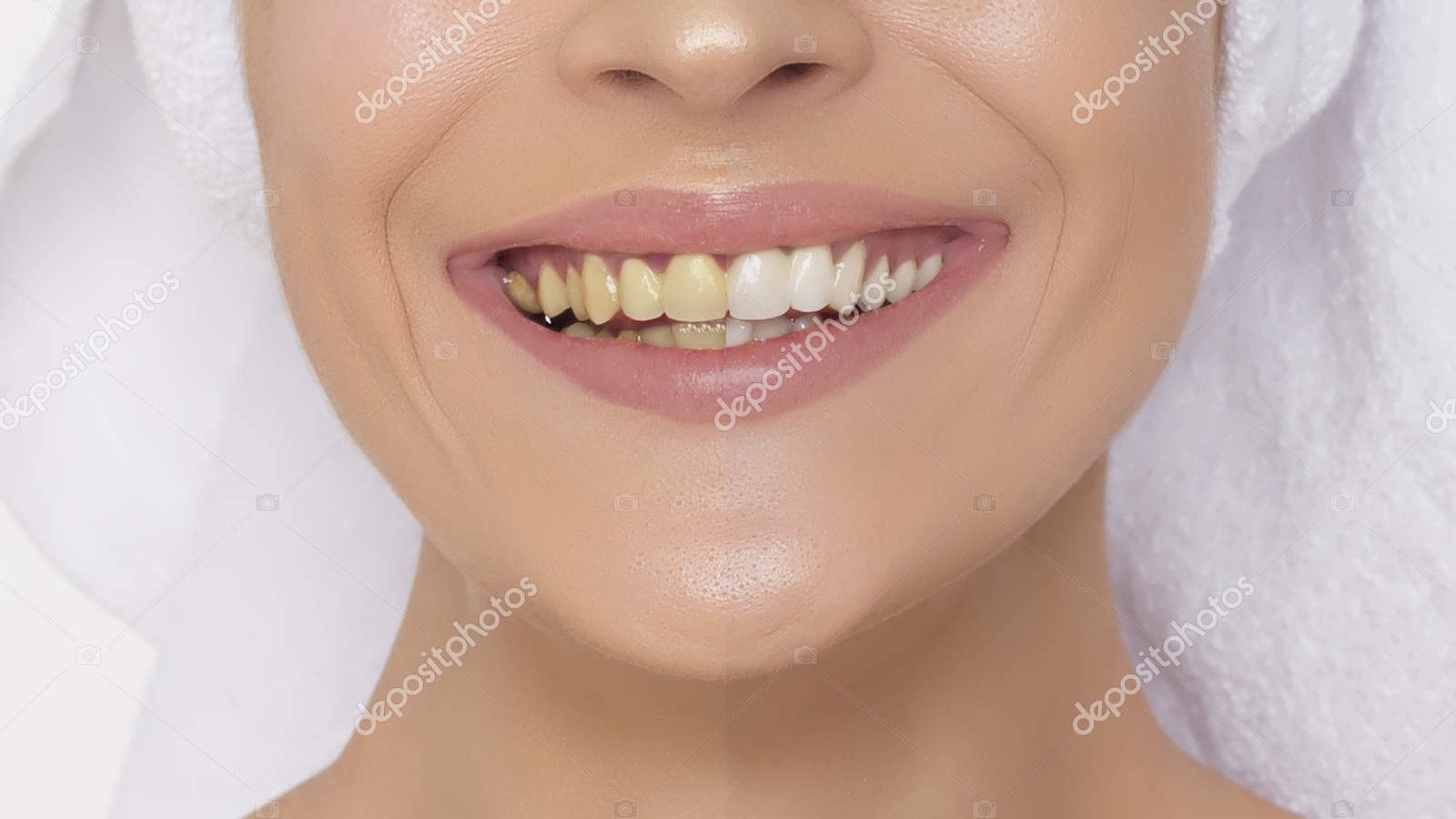stained-teeth-sample stained-teeth-sample