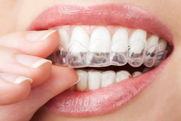 teeth with whitening tray