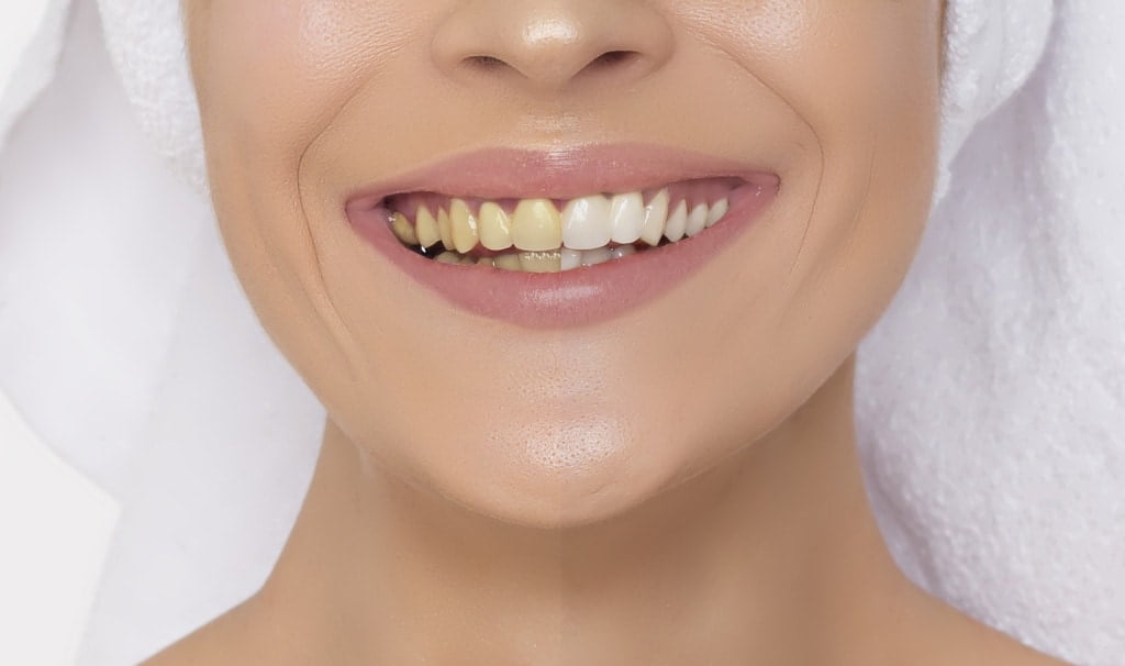 Teeth whitening: A woman with half of her teeth whitened