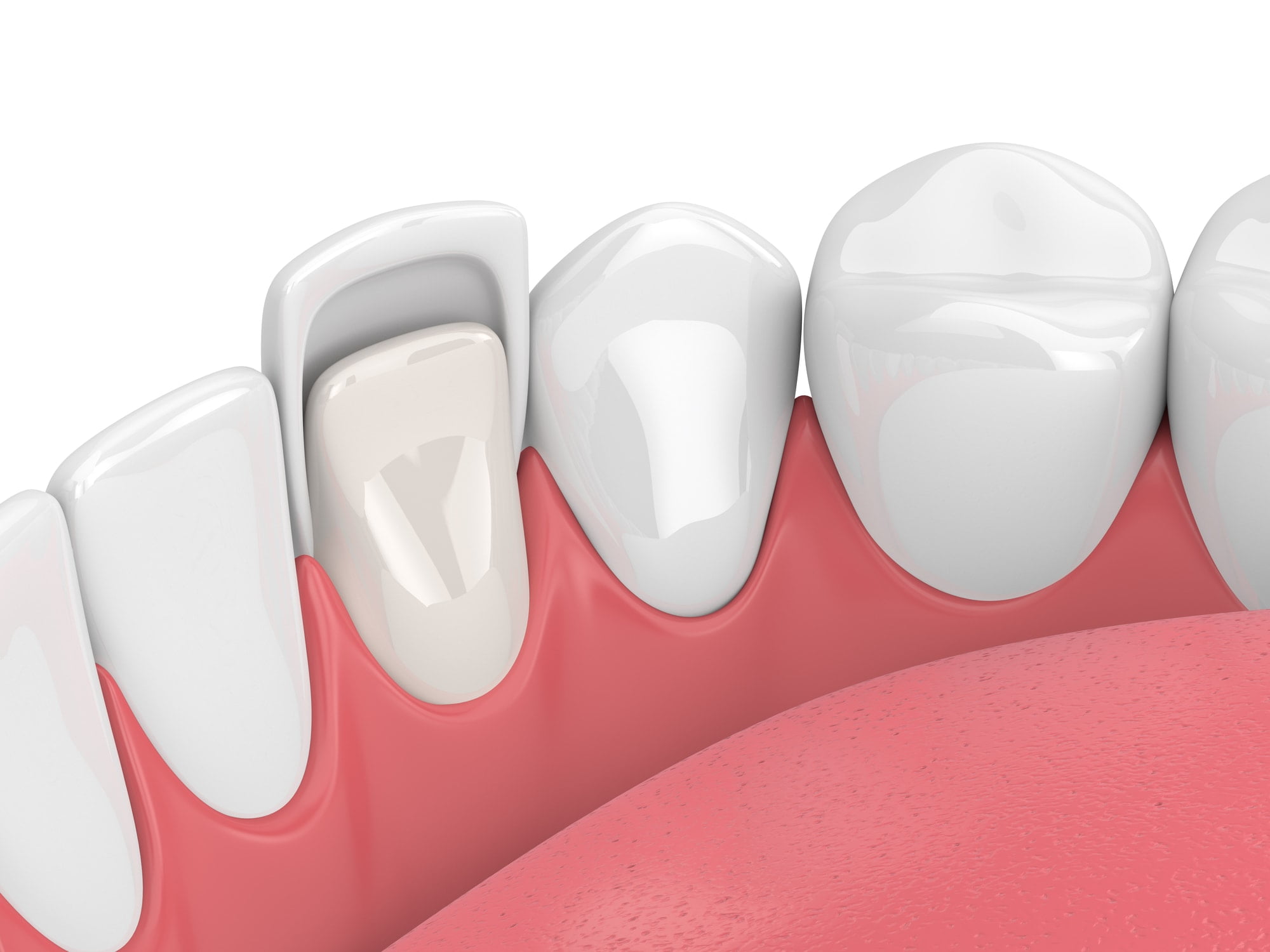 3d render of teeth with veneer over white
