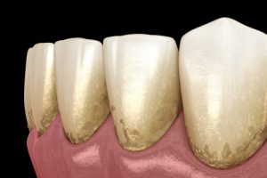 Fluoride Treatment for increasing chances of developing plaque & tartar on tooth