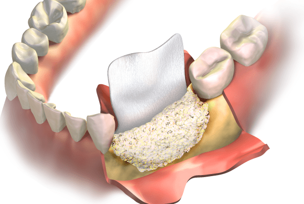 bone-grafting-banner