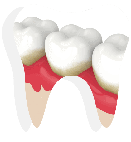 gum-treatment