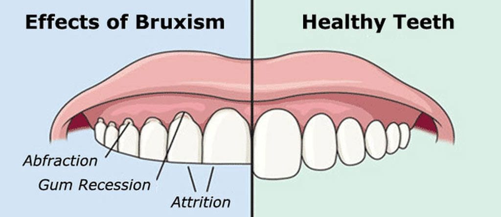 ASD_effects of bruxism_healthy teeth