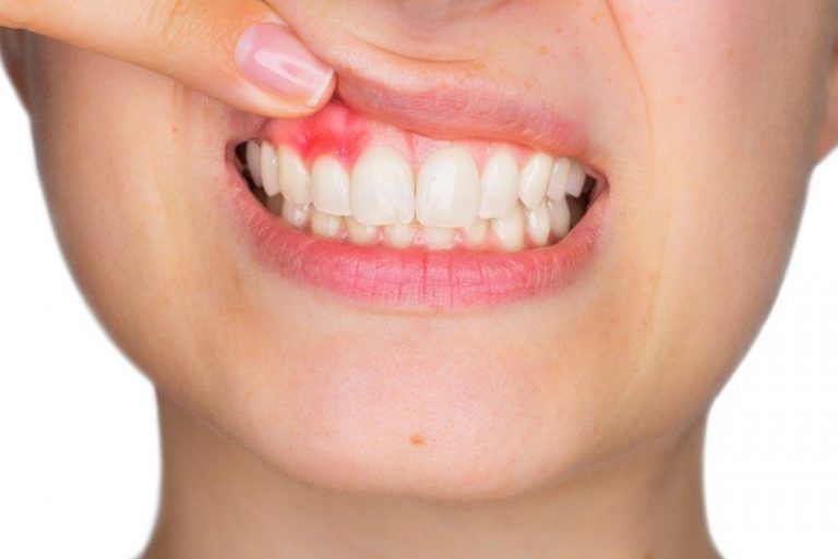 Close-up of teeth and gums with the upper lip lifted