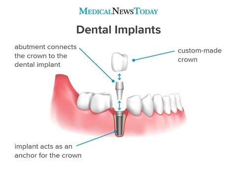 medicalnewstoday_dental implant
