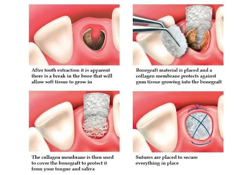 bone grafting diagram