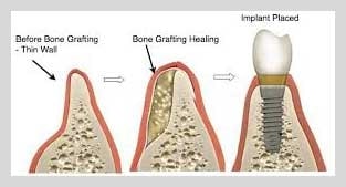 extensive and complicated bone grafting procedure