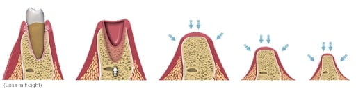 why is bone grafting needed_1