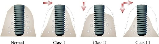 why is bone grafting needed_2