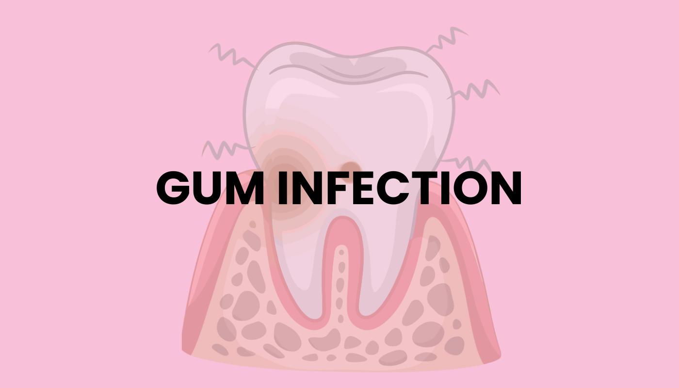 Gum Infection: Symptoms, Causes & Treatment